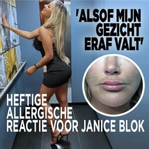 Heftige allergische reactie voor Janice Blok: &#8216;Alsof mijn gezicht eraf valt&#8217;
