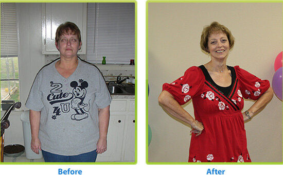 Before and after weight loss surgery in Dallas